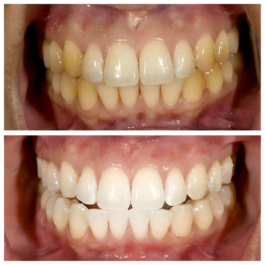 Niacinamide Whitening Toothpaste - For Healthier, Whiter Teeth!