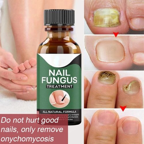 Fast Nail Fungal Treatment Serum