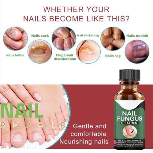 Fast Nail Fungal Treatment Serum
